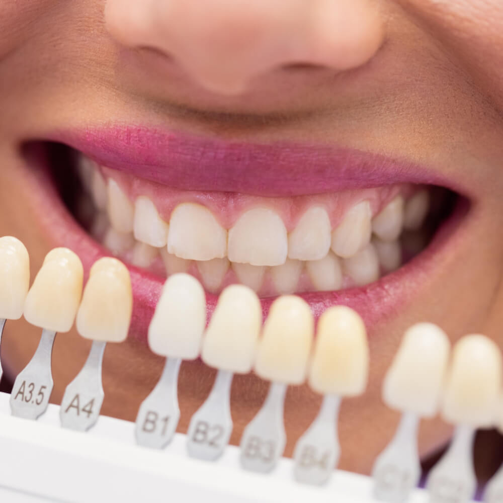 Tratamiento de carillas dentales